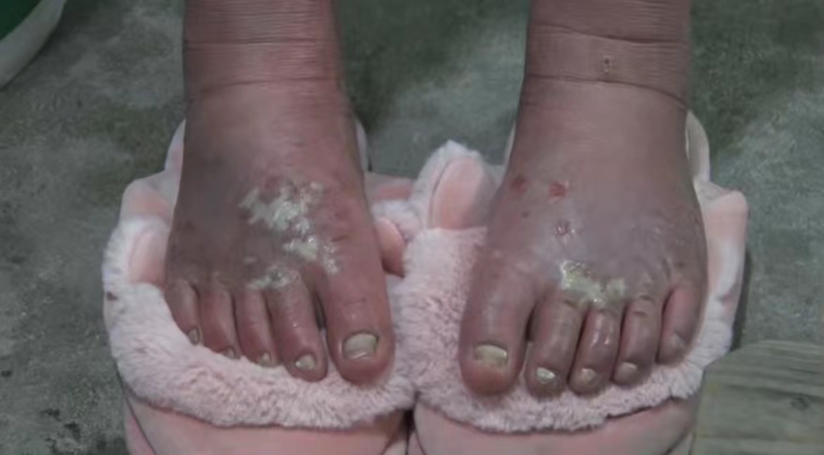 九江修水：女孩四年雙腳發(fā)燙  整天泡冰水降溫